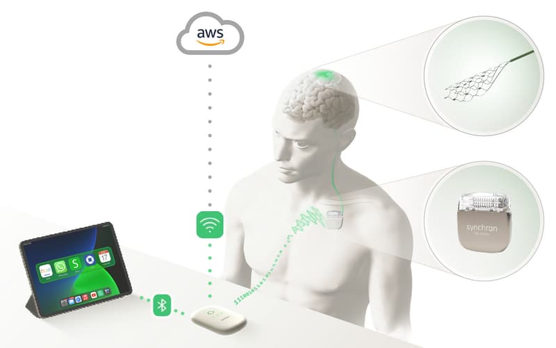 Американската компания Synchron създаде мозъчен имплант с вграден ChatGPT