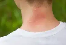 Защо комарите ви хапят по-често от другите?